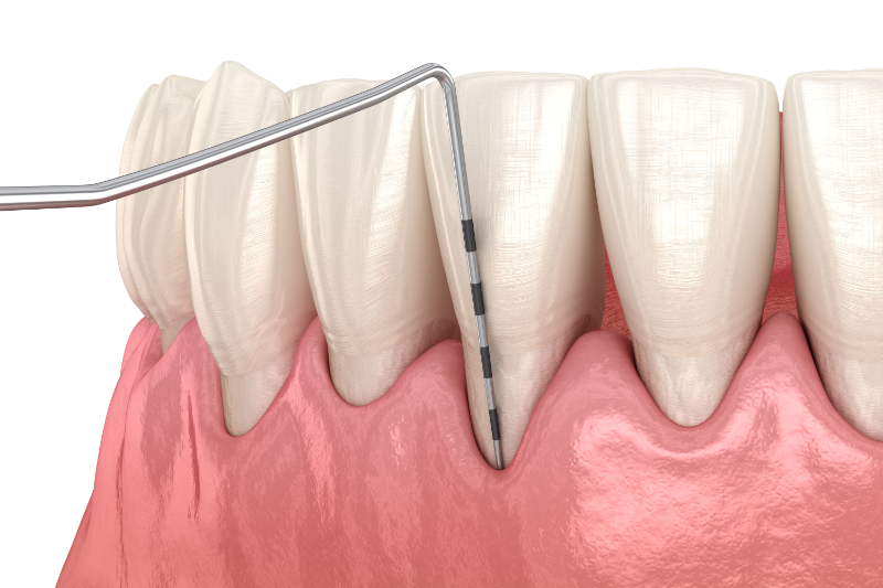 Parodontosebehandlungen