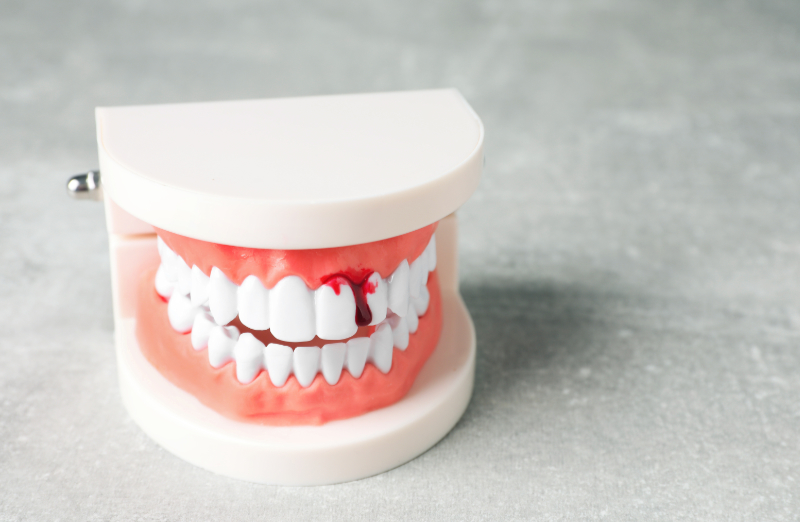 Zahnfleischbehandlungen