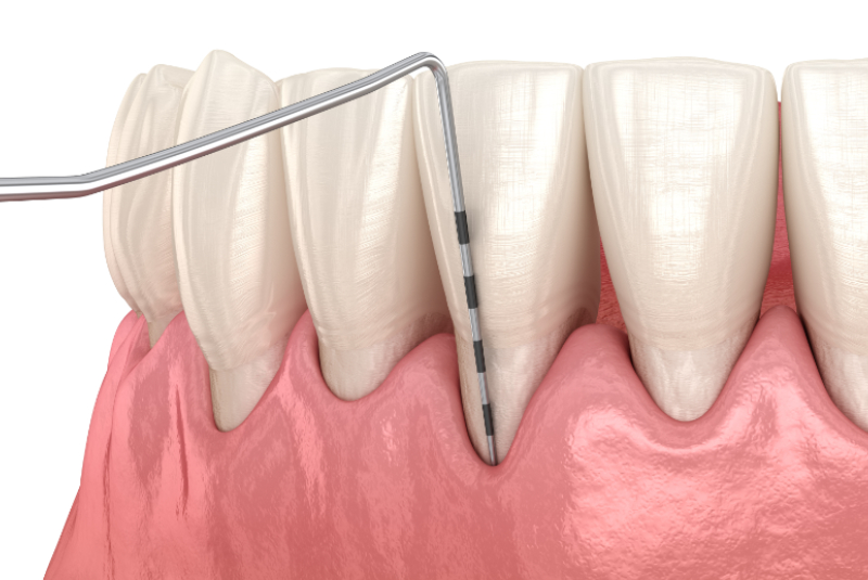 Parodontosebehandlung