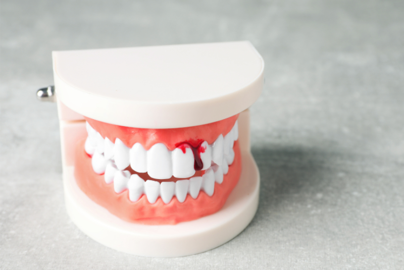 Zahnfleischbehandlung